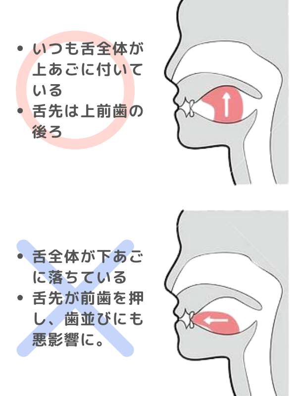 正しくは、いつも舌全体が上あごに付いていて、舌先は上前歯の後ろ。舌全体が下あごに落ちている のはダメで、舌先が前歯を押してしまって歯並びにも悪影響に。